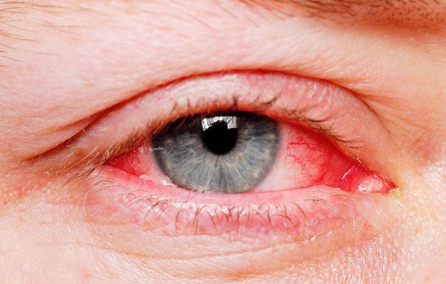 Đau mắt đỏ có lây không? Cách phòng ngừa đau mắt đỏ
