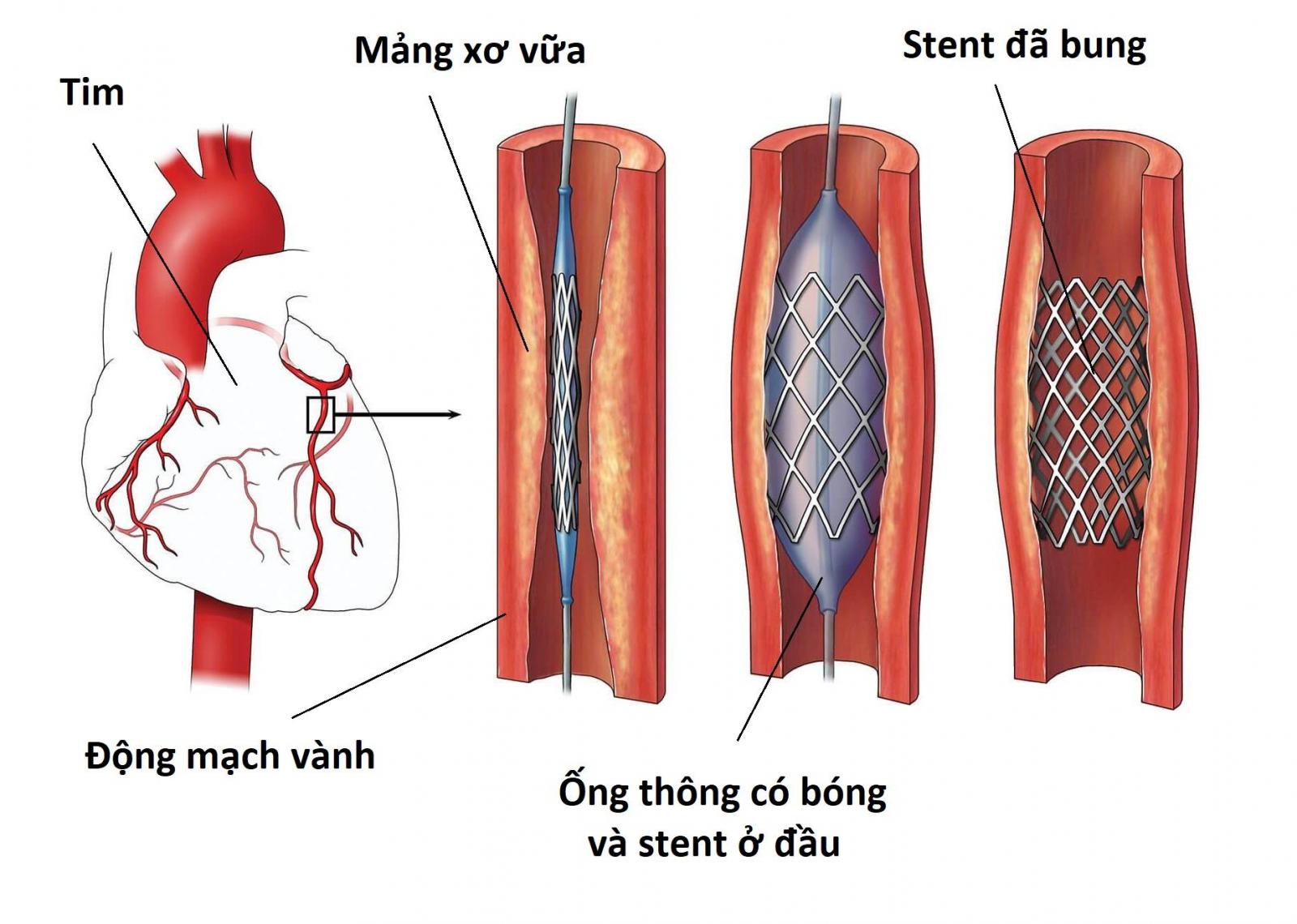 Kỹ thuật đặt stent mạch vành