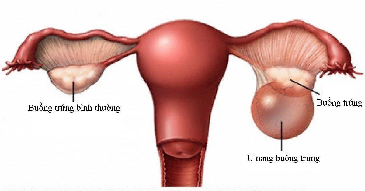 Các u nang buồng trứng có kích thước lớn có thể bị vỡ và nhiễm trùng