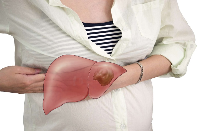 Đau hạ sườn phải và vùng bụng trên có thể là dấu hiệu ung thư gan giai đoạn đầu
