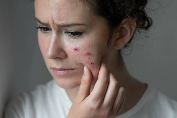 Không nên đắp mặt nạ nếu da bị mụn viêm nghiêm trọng.