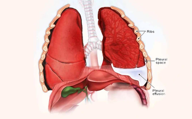 5 nguyên nhân gây tràn dịch màng phổi thường gặp nhất