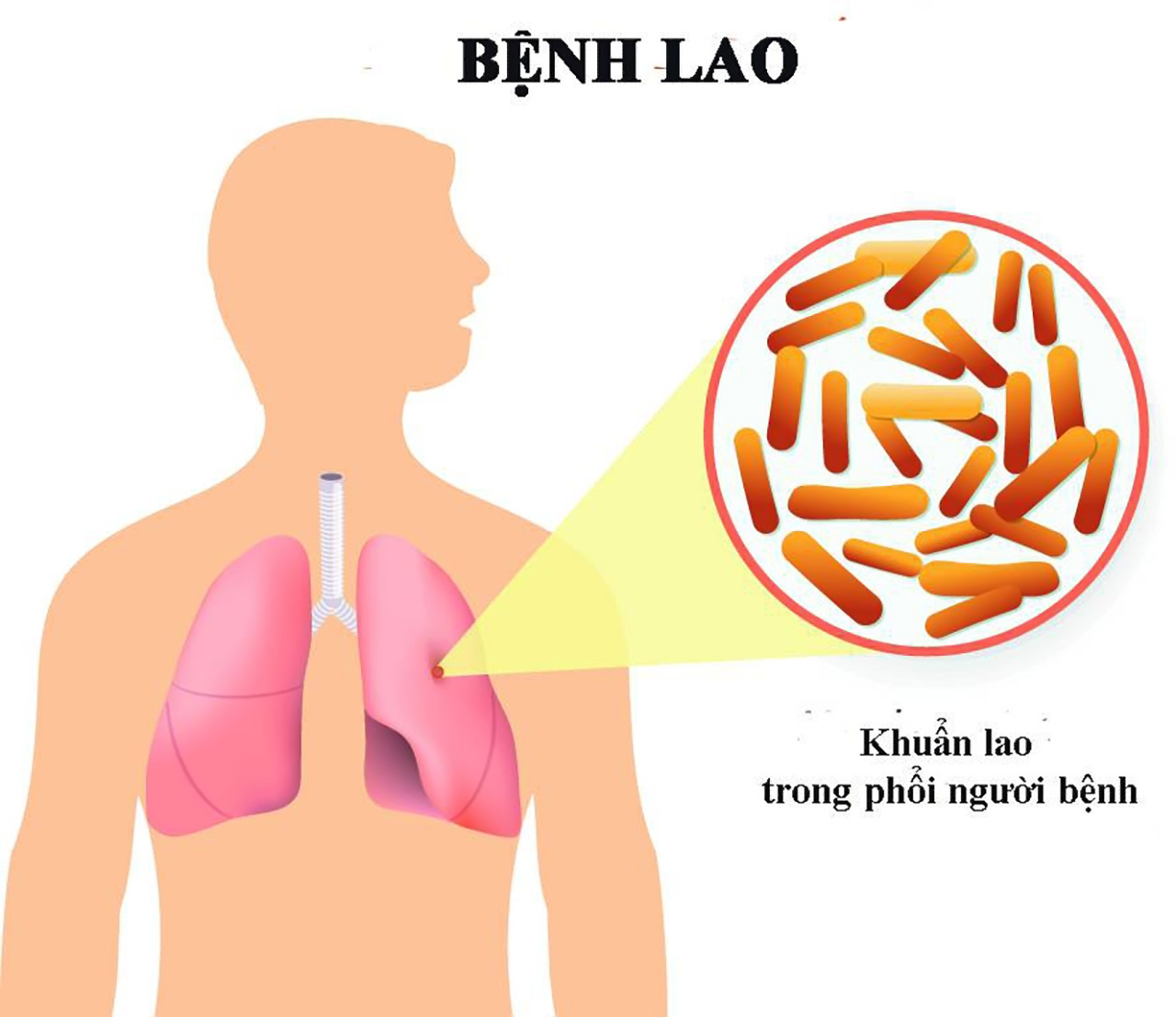 Tràn dịch màng phổi do lao là tình trạng thường gặp nhất
