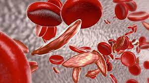 Thiếu máu hồng cầu hình liềm gây vàng da
