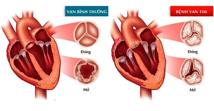 Hở van tim là gì? Hở van tim có nguy hiểm không?