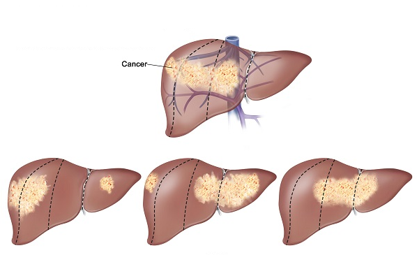 Hình ảnh ung thư gan
