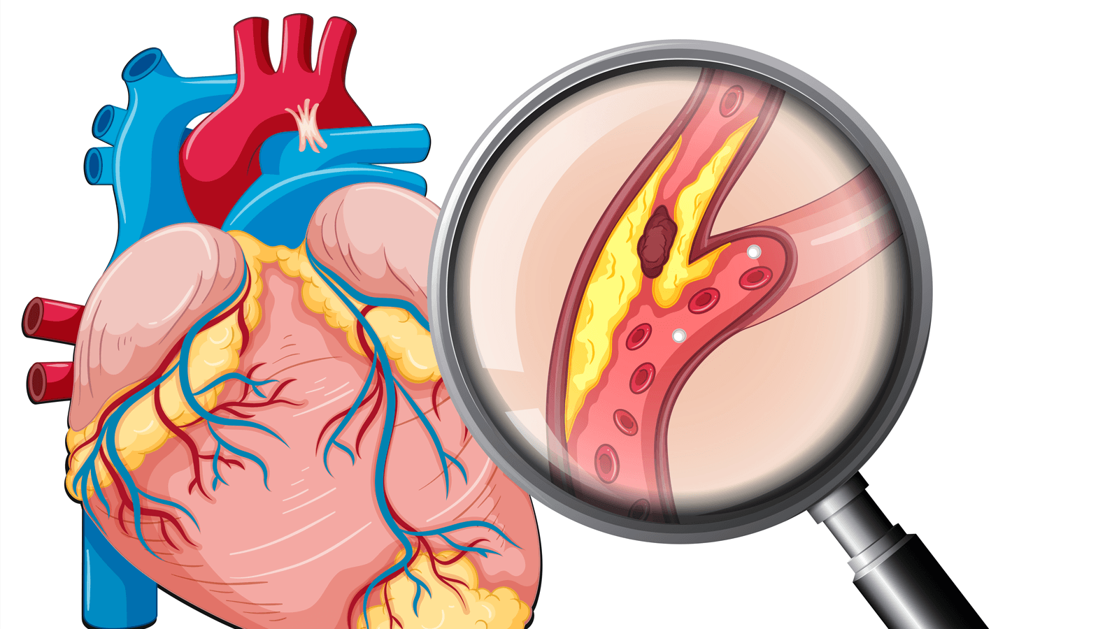 Xơ vữa động mạch vành gây ảnh hưởng đến tim