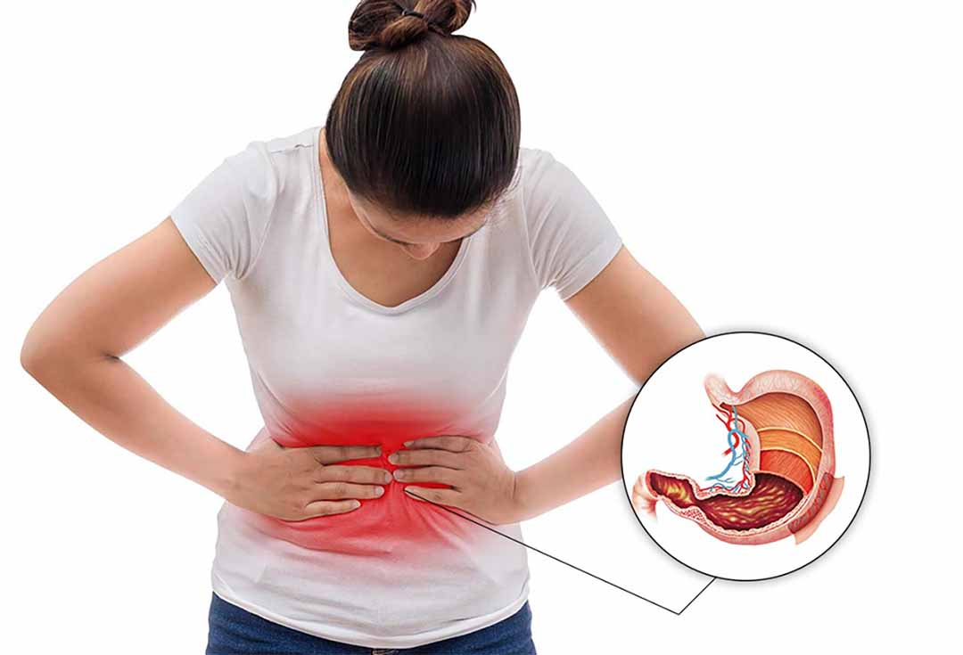 Loét dạ dày gây đau bụng vùng thượng vị