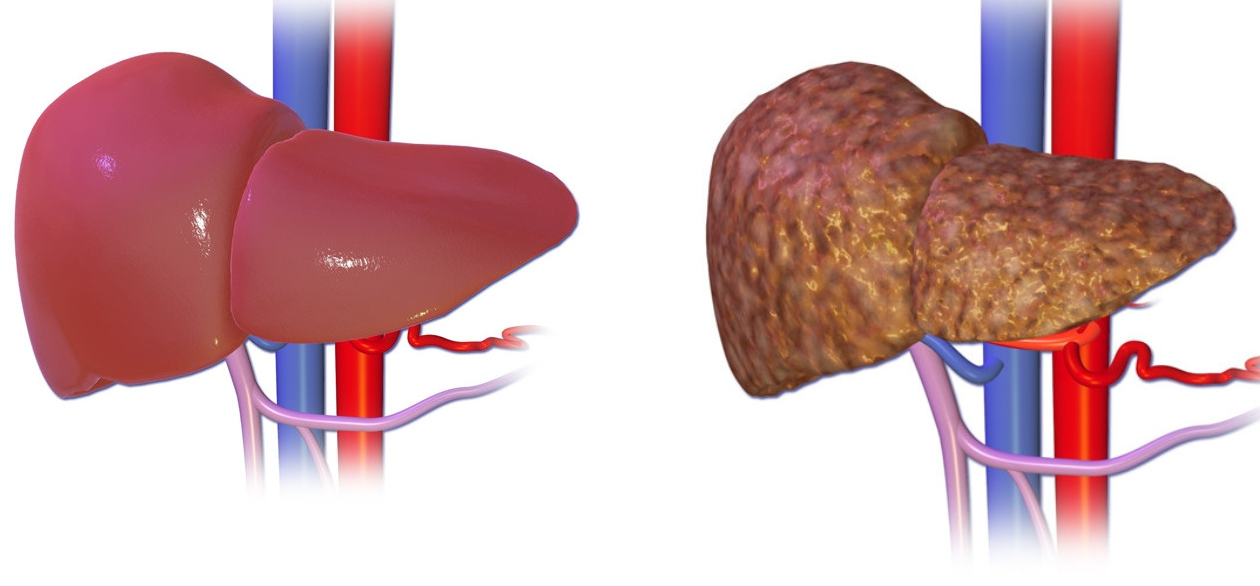 Gan bình thường (trái) và gan của bệnh nhân xơ gan (phải)