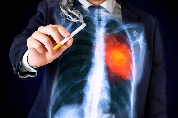 Người hút thuốc lá là đối tượng có nguy cơ cao bị lao phổi