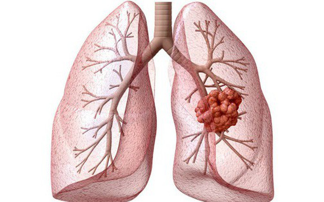 Ung thư phổi: Nguyên nhân, triệu chứng, cách điều trị và phòng ngừa