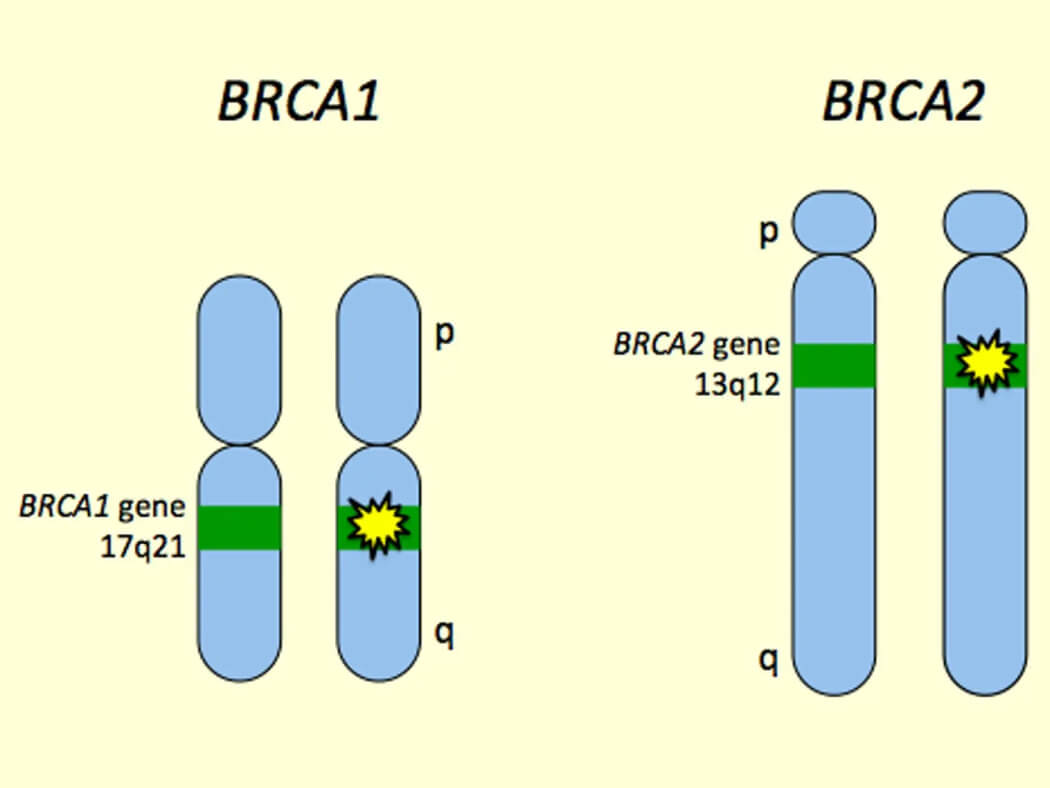  Đột biến gen BRCA1 và BRCA2 là nguyên nhân chính gây ung thư buồng trứng