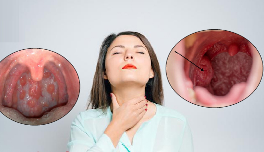 Ung thư vòm họng là gì? Bệnh có nguy hiểm không?