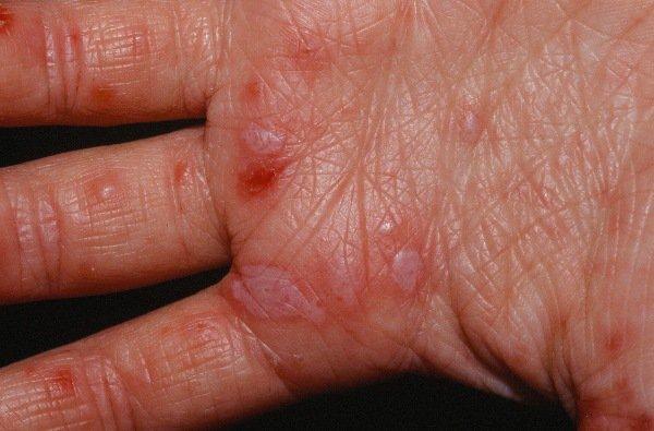 Nốt phỏng trên da tay là biểu hiện điển hình của bệnh