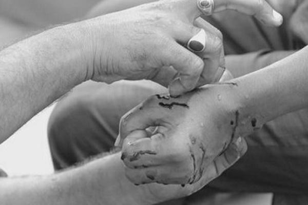 “Đào thải máu độc” bằng cách rạch dao lam lên người, bé trai 10 tuổi tử vong