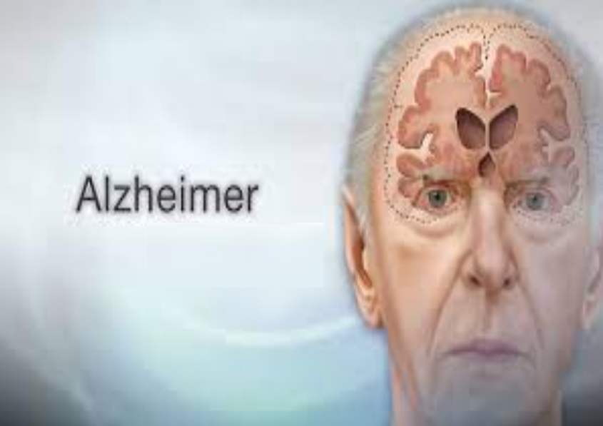 Ăn tỏi đúng cách giúp giảm nguy cơ mắc bệnh Alzheimer