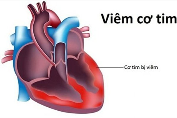 Viêm cơ tim: Nguyên nhân, triệu chứng và cách điều trị