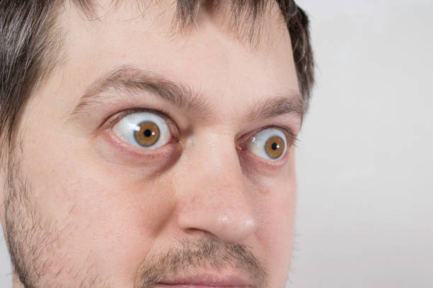 Lồi mắt là biến chứng có thể gặp ở bệnh cường giáp.