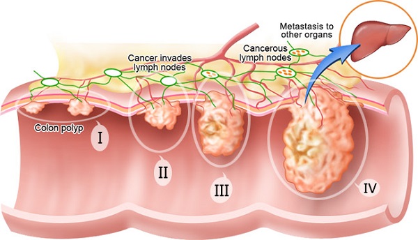 Ung thư đại tràng giai đoạn 3 điều trị thế nào?