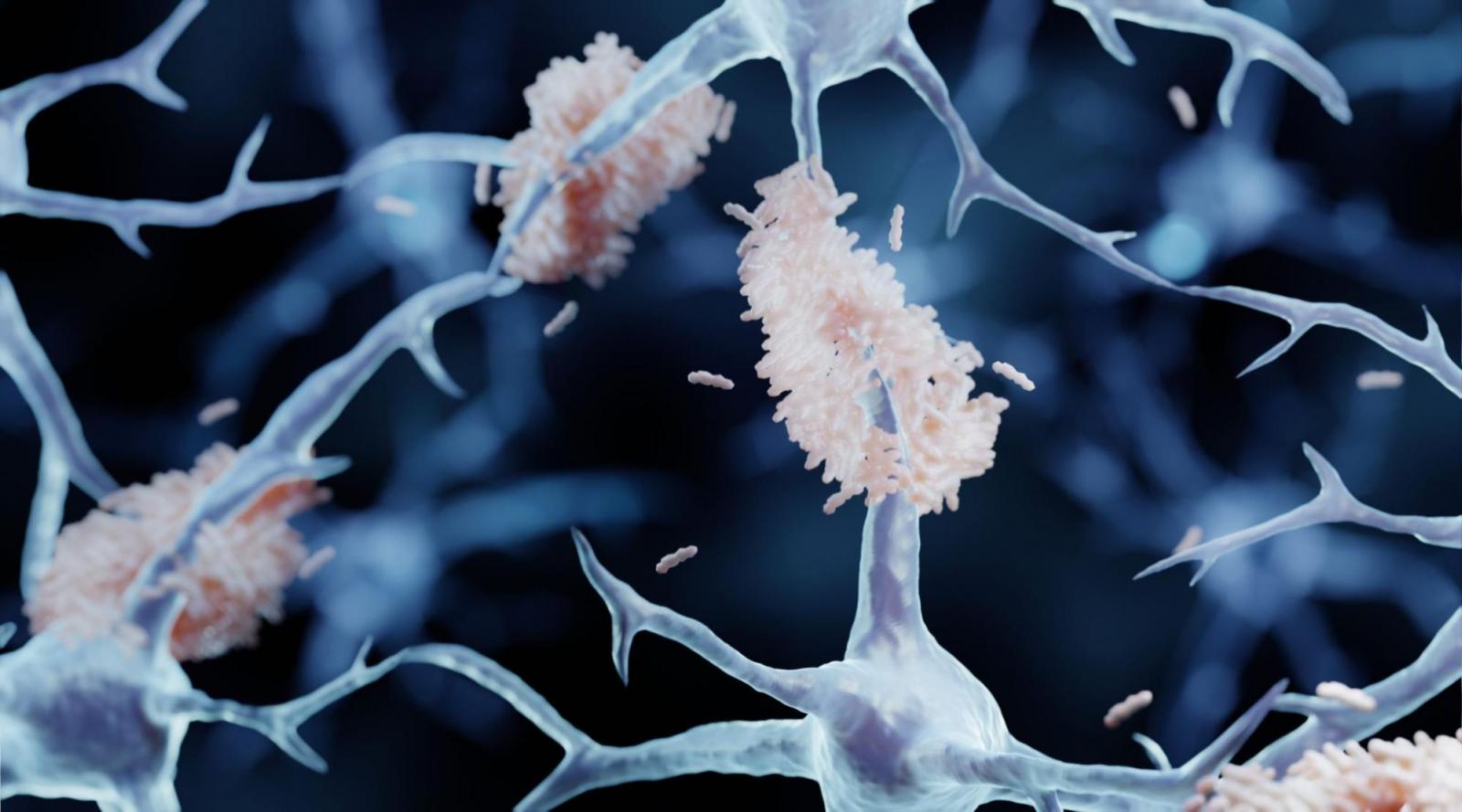 Amyloid tích tụ trong não sẽ dẫn đến bệnh Alzheimer