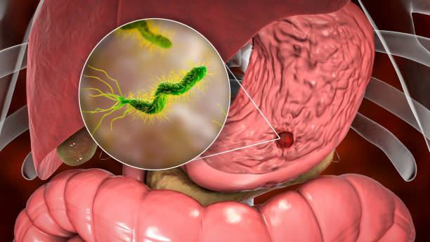 Vi khuẩn HP (Helicobacter Pylori) gây hại cho dạ dày