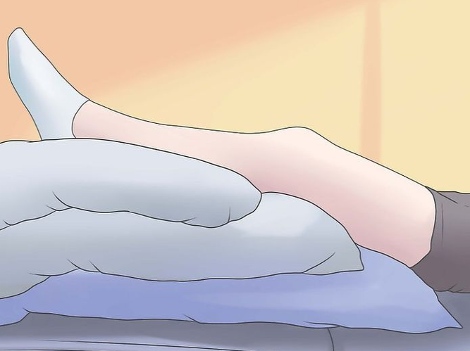  Người bị suy giãn tĩnh mạch nên kê cao chân khi ngủ