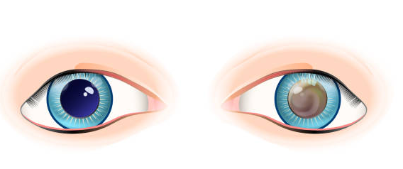  Hình ảnh mắt bình thường (bên trái) và mắt bị ung thư võng mạc (bên phải)