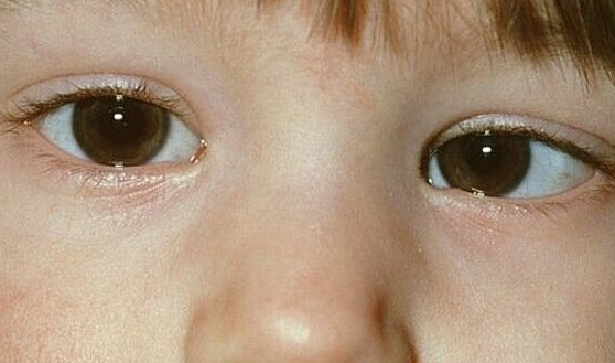 Mắt lác- triệu chứng ung thư võng mạc