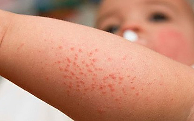 Phát hiện sớm sốt xuất huyết giúp phòng ngừa biến chứng nặng