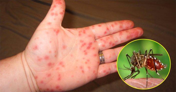 Sốt xuất huyết do virus Dengue gây ra