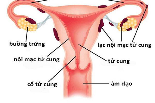 Hình ảnh minh họa lạc nội mạc tử cung.