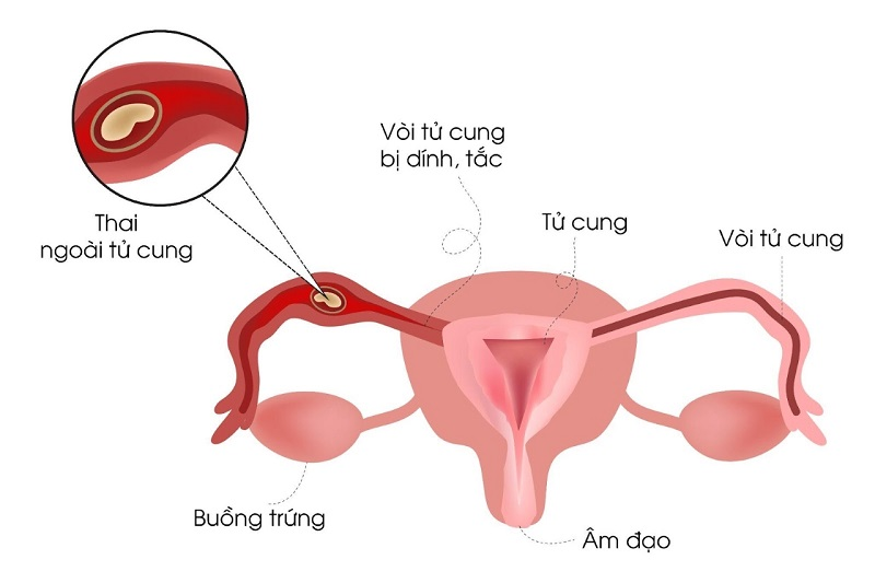 Viêm phần phụ có thể dẫn đến mang thai ngoài tử cung.