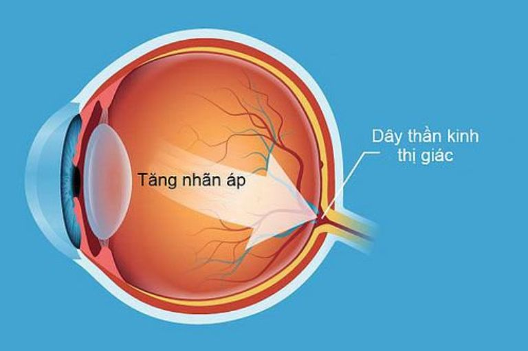 Biến chứng tăng nhãn áp khiến thị lực suy giảm, có thể dẫn tới mù lòa.