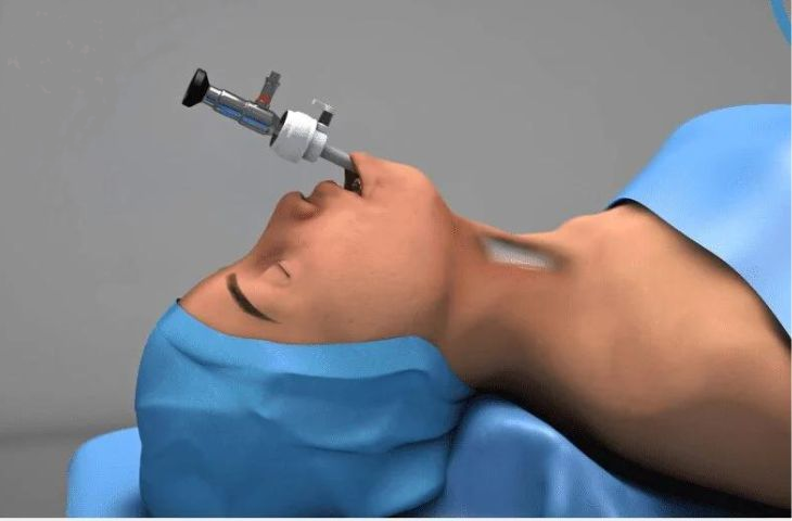 Minh họa phẫu thuật cắt bỏ tuyến giáp xuyên miệng