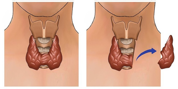 Minh họa phẫu thuật cắt thùy tuyến giáp