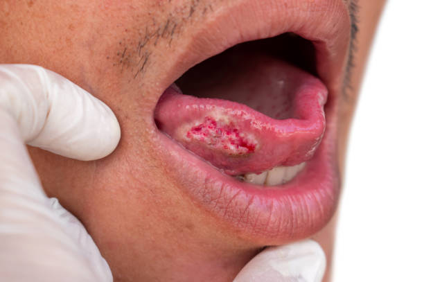 Hình ảnh vết loét của bệnh ung thư lưỡi