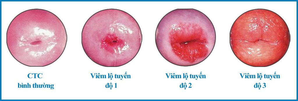 3 cấp độ viêm lộ tuyến cổ tử cung