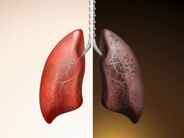 Nhiễm độc phổi là căn nguyên hình thành các bệnh lý mãn tính ở phổi