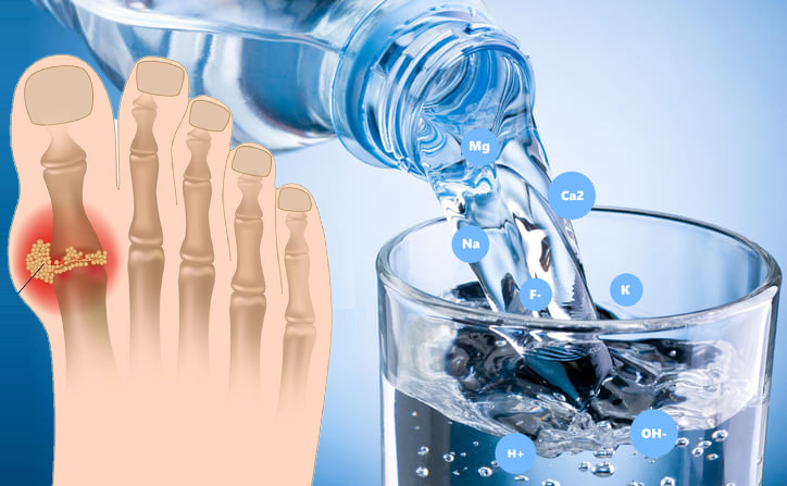 Vì sao người bệnh gút nên uống nước ion kiềm?