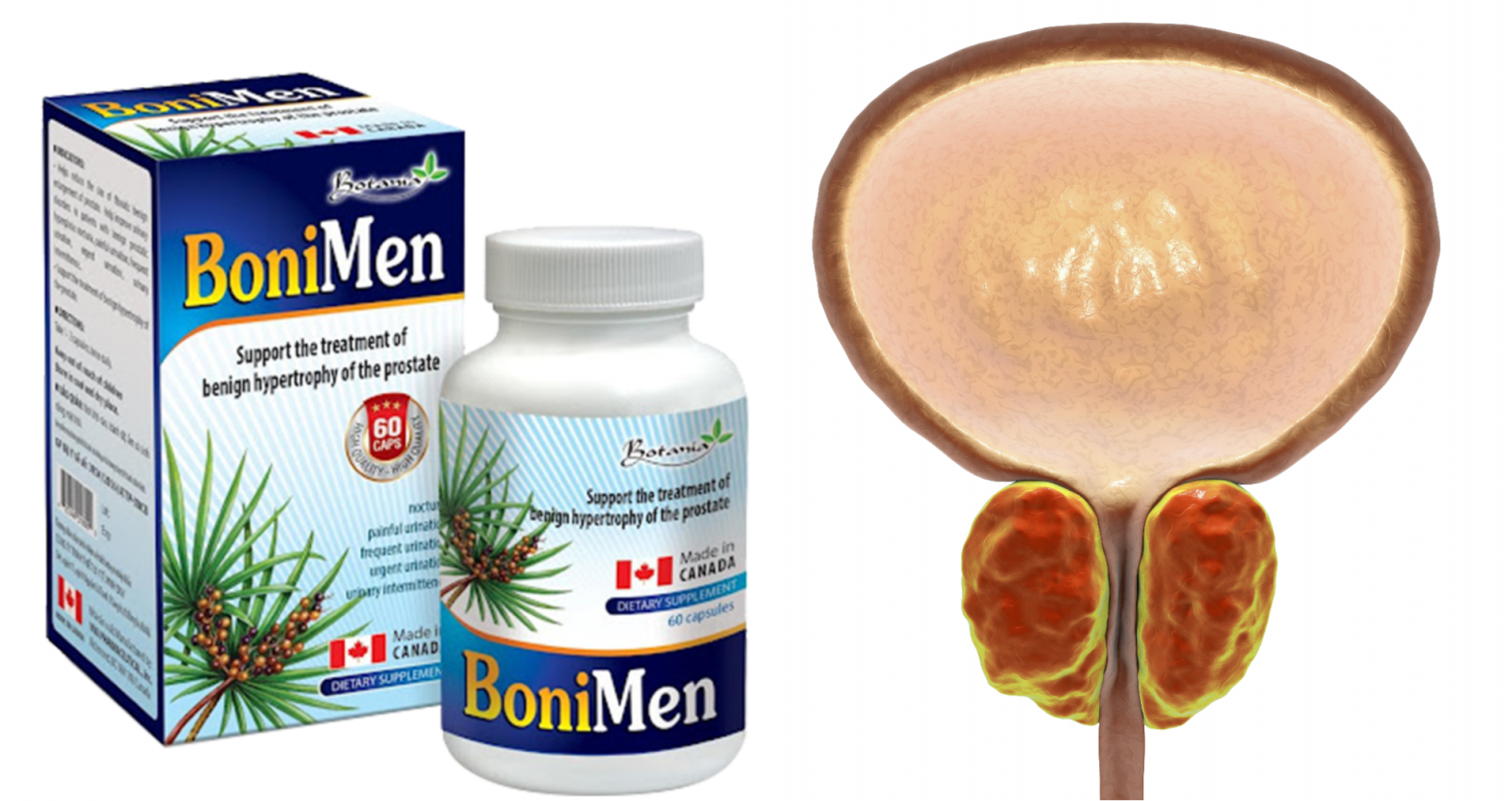 BoniMen giúp cải thiện bệnh phì đại tuyến tiền liệt