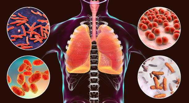 Triệu chứng lao phổi tái phát và cách phòng ngừa