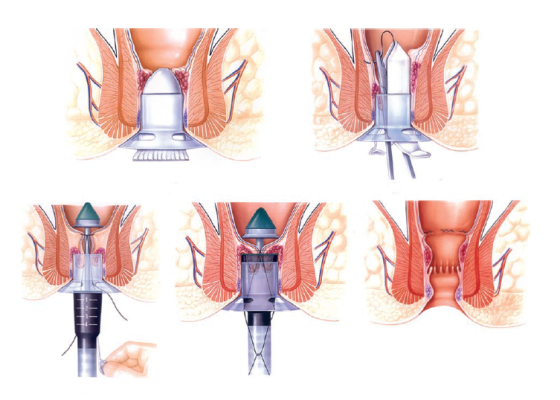  Các bước phẫu thuật longo cắt trĩ