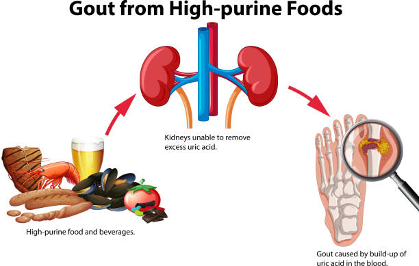 Ăn quá nhiều thực phẩm giàu purin làm tăng nguy cơ bệnh gout