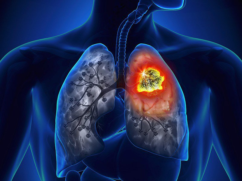 Bệnh phổi tắc nghẽn mạn tính có thể dẫn đến ung thư phổi.