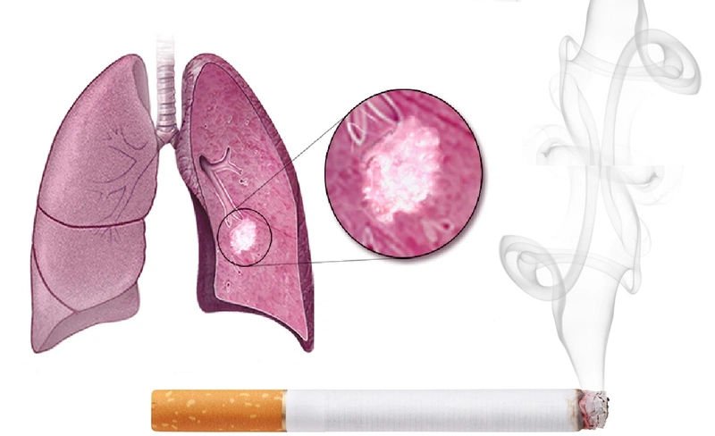 80 - 90% trường hợp mắc bệnh phổi tắc nghẽn mãn tính do hút thuốc lá