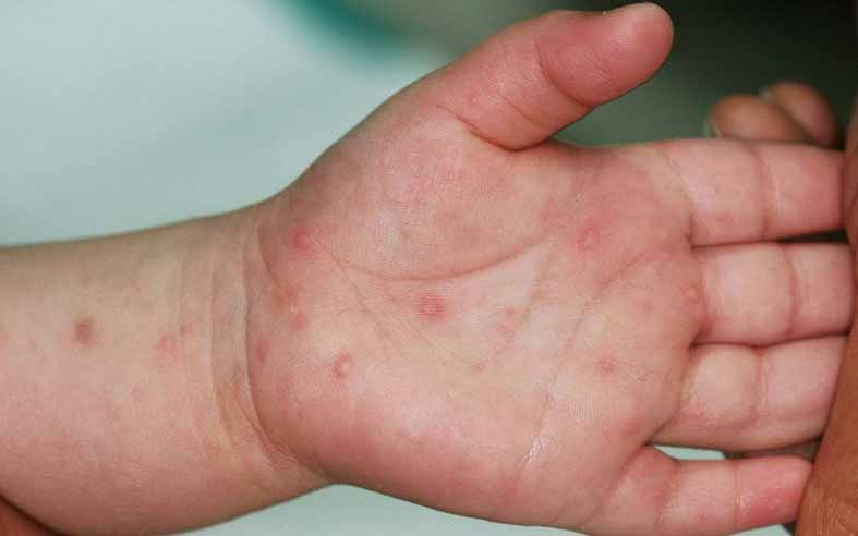 Trẻ bị tay chân miệng thường có những tổn thương ở da.